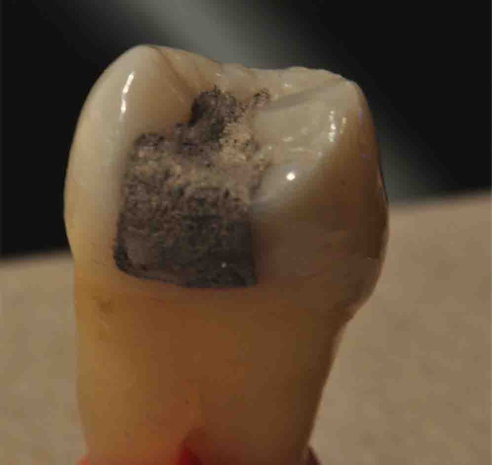 silver filling amalgam fillings dental treatment options mercury dentistry