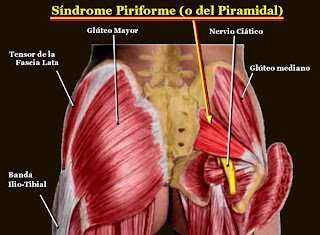 Pyramidal Syndrome 2