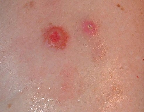 Minor+spider+ite+pictures spider bites symptoms in children. Minor+spider+ite+pictures