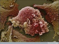 Et voici des cellules cancéreuses du poumon!
