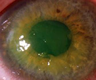 Recurrent Corneal Erosion