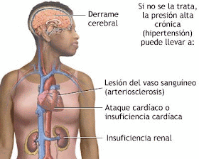 Hemorragia cerebral con presión arterial Hemorragia cerebral con presión arterial