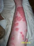 After using "Soothing" lotion for 1 week.