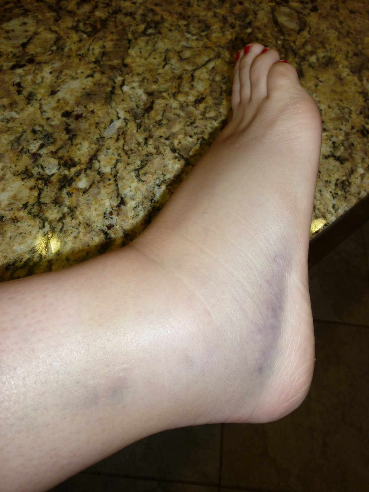 Pinney Family Skinned Knees and Fat Ankles