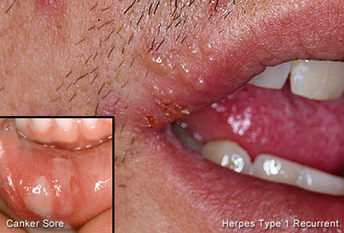 herpe lesion pictures #10