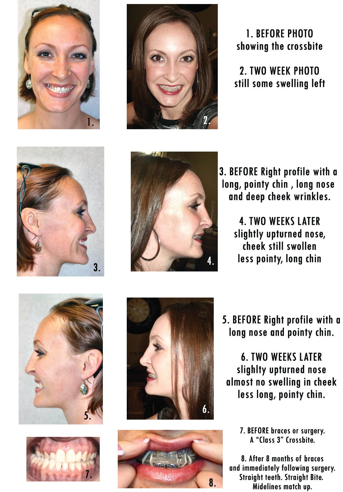 Double Jaw Surgery Before/After two weeks