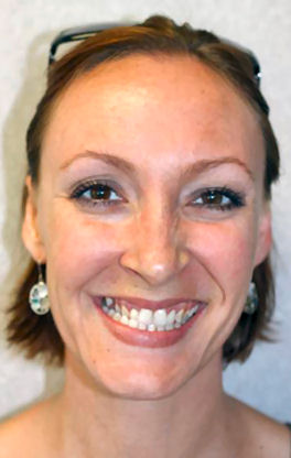 Double Jaw Surgery: 2 Months!