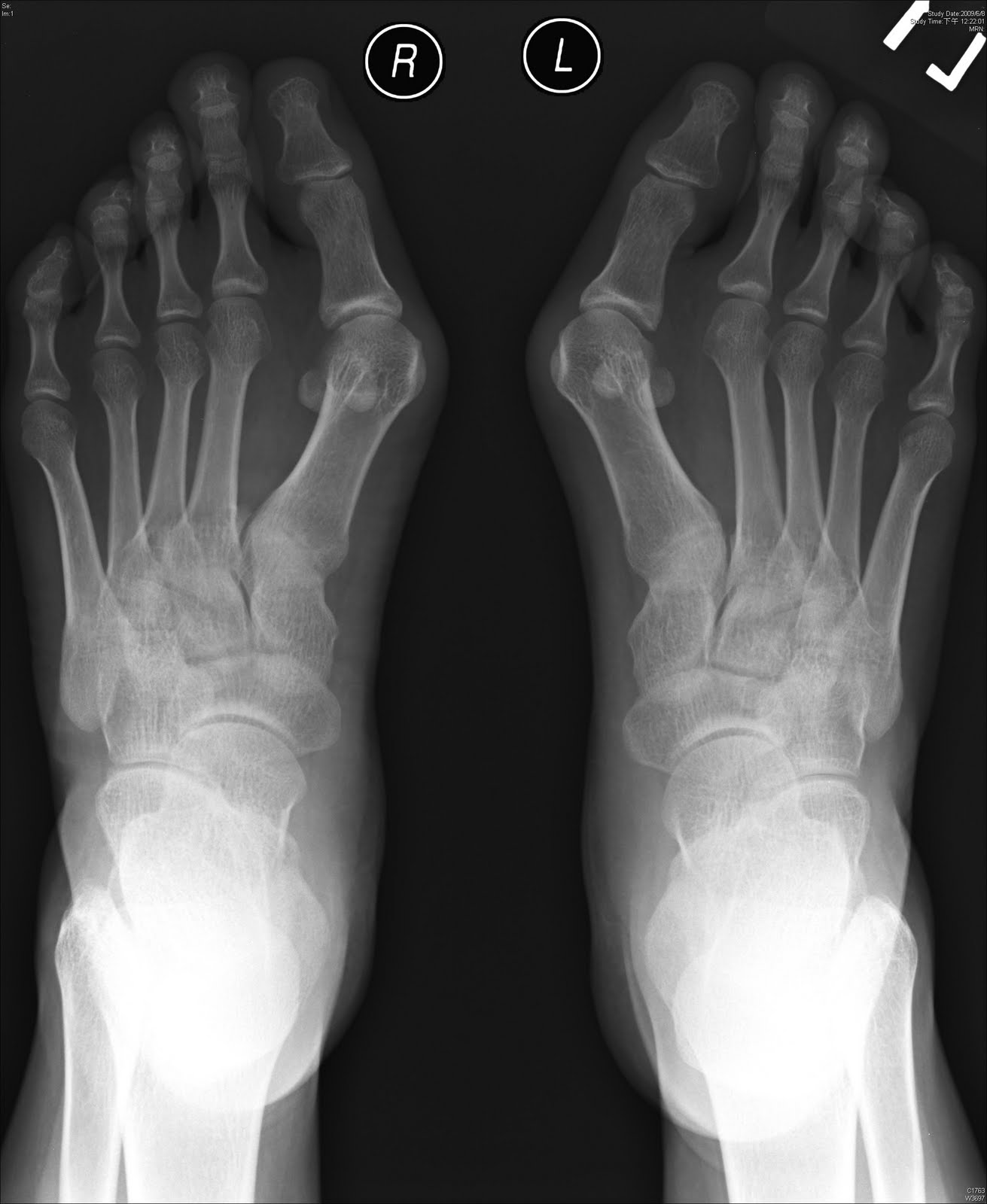 Деформация пальцев стопы мкб. Hallux valgus степени рентген. Степени халюса вальгуса рентген. Халюкс вальгус рентген.