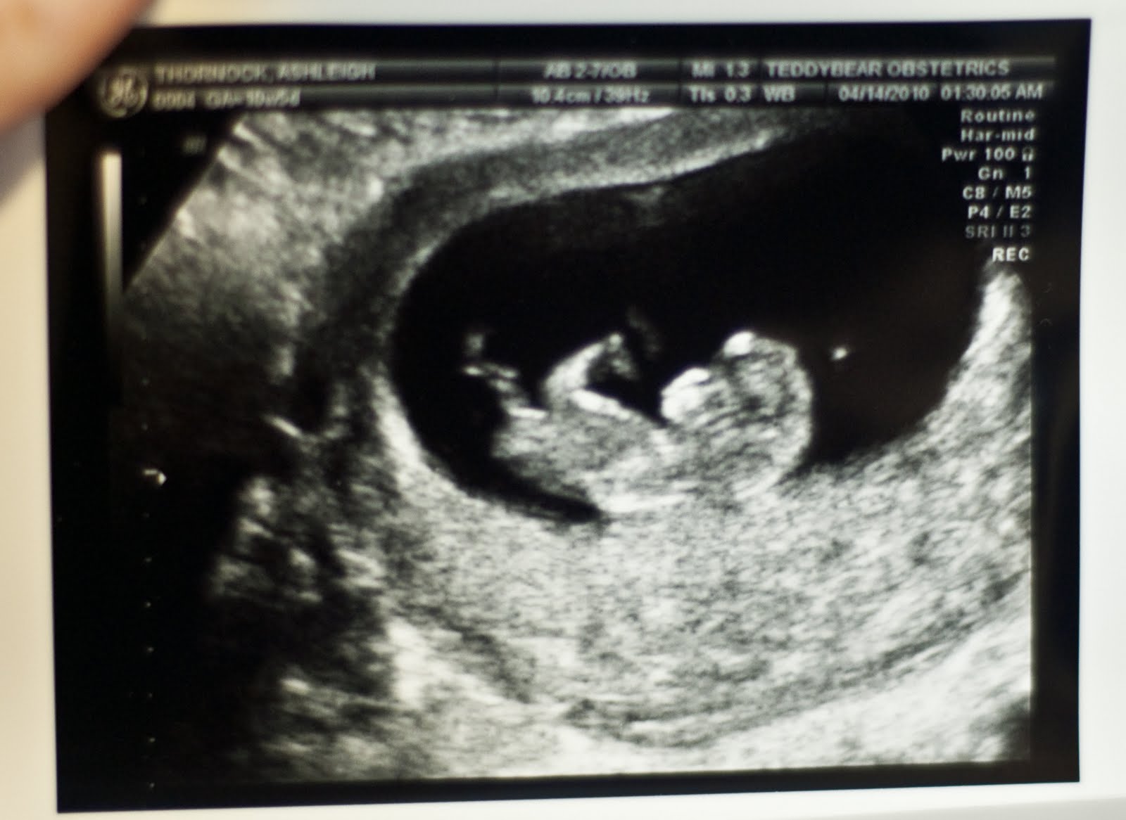 Can a dating scan be done at 7 weeks