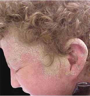 Crusted Scabies Pictures