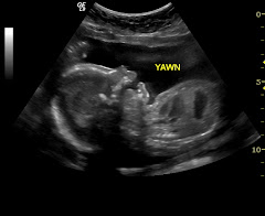 Baby Girl Yawning! 21 weeks