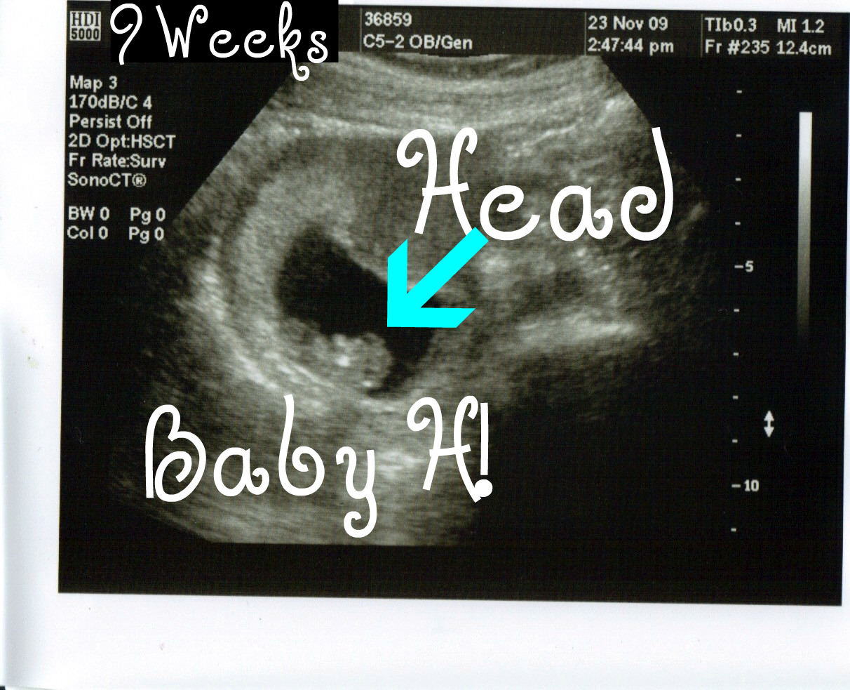 The Family Hossenlopp: Ultrasound at 9 weeks & 2 days