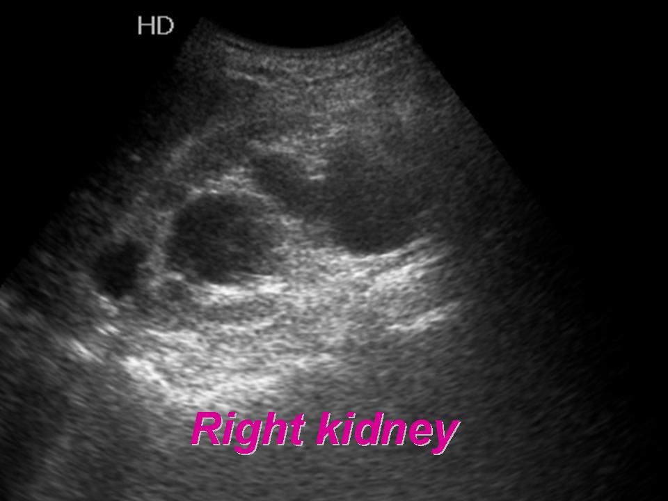 Pelvic Ultrasound Kub And Pelvic Ultrasound