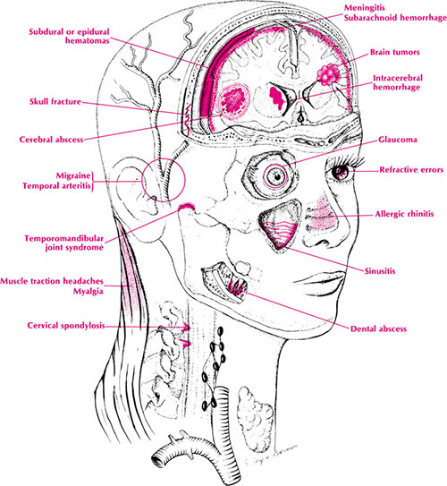 Phimaimedicine 723 headache approach
