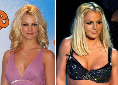 Celebrity Boob Jobs Before And After 24