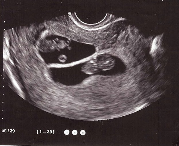 Pickles & Olives: Week 9 Ultrasound