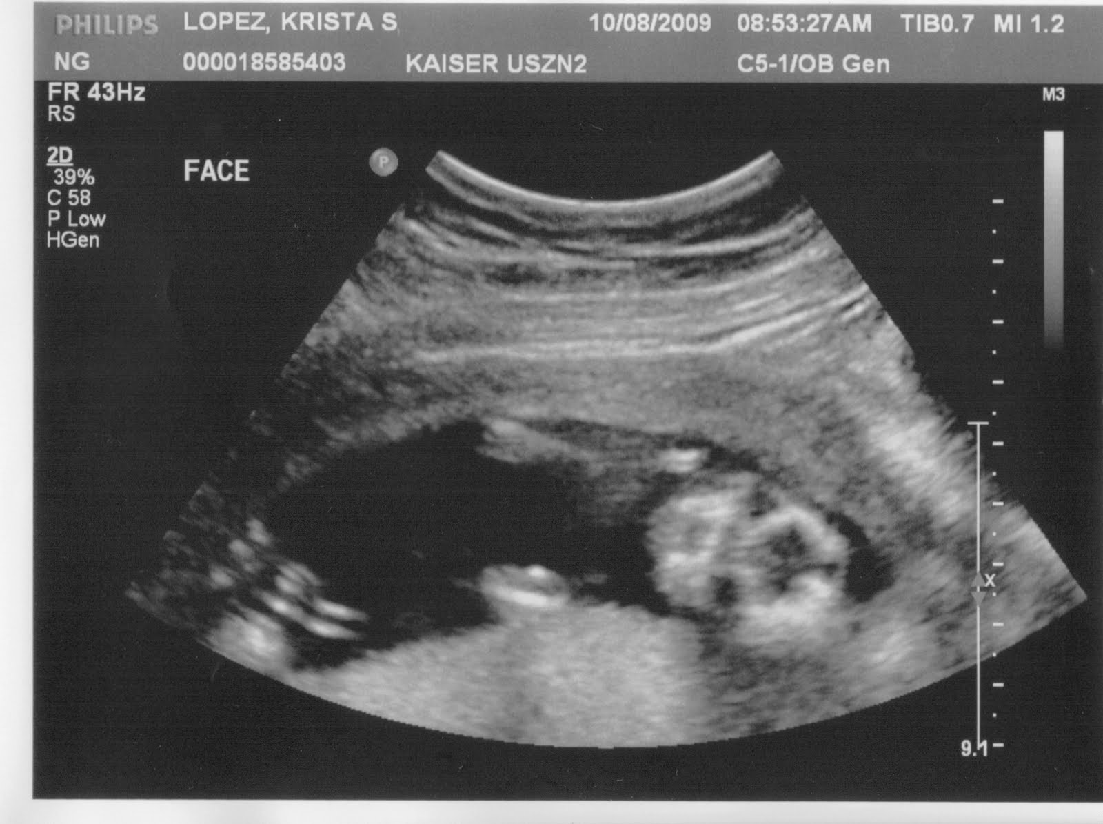 [Ultrasound+10-8-09+Face+2+with+pose.jpg]