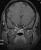 Empty Sella and CSF Rhinorrhea-MRI & CT - Sumer's Radiology Blog