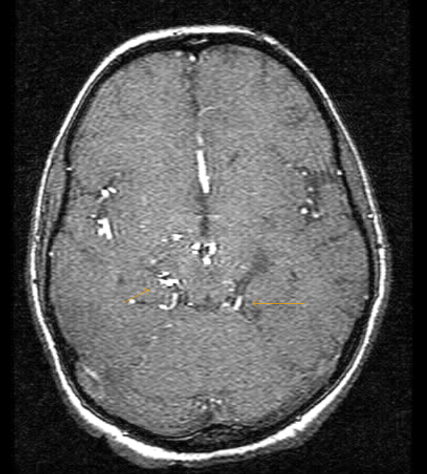 Moya Moya DiseaseMRI Sumer's Radiology Blog