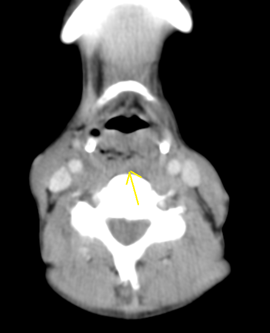 Post Cricoid CarcinomaCT Sumer's Radiology Blog