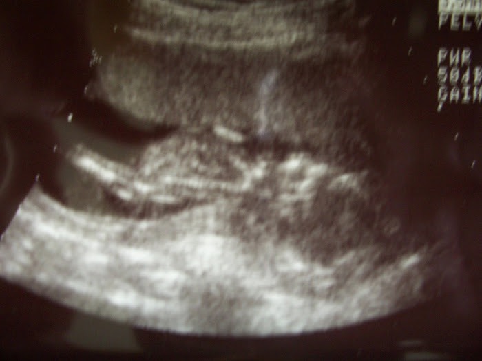 13 Weeks Sonogram 2