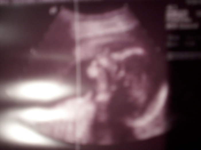 22 Week Sonogram II
