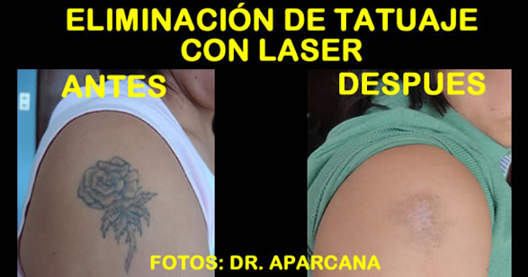 Eliminación de Tatuaje con Laser