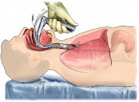 UTI - Intubação