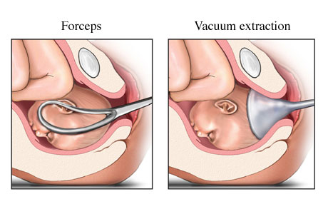 Entendendo as possíveis intervenções: Fórceps e Vácuo-Extrator - Pra valer a pena