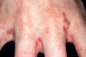 Scabies Symptoms - Mayo Clinic