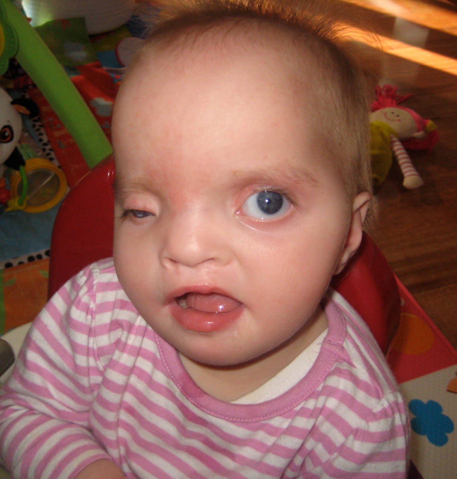 Анофтальм. Микрофтальм анофтальм. Микрофтальмия у новорожденных. Врожденное отсутствие глаз. Врожденное отсутствие глазных яблок.