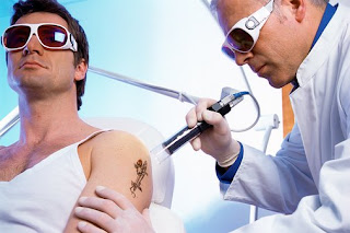  Tattoo Removal Methods Differ From Laser Tattoo Removal: Tattoos and Tattoo Pictures22222