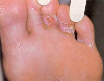 Splitting between toes | Foot Health Forum
