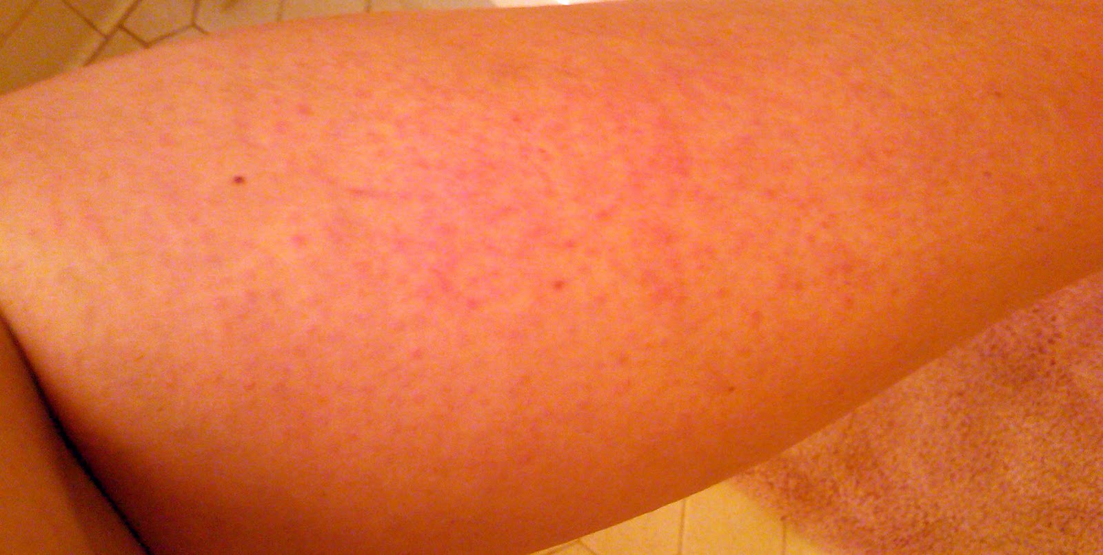 Swollen Legs With Red Mass 66