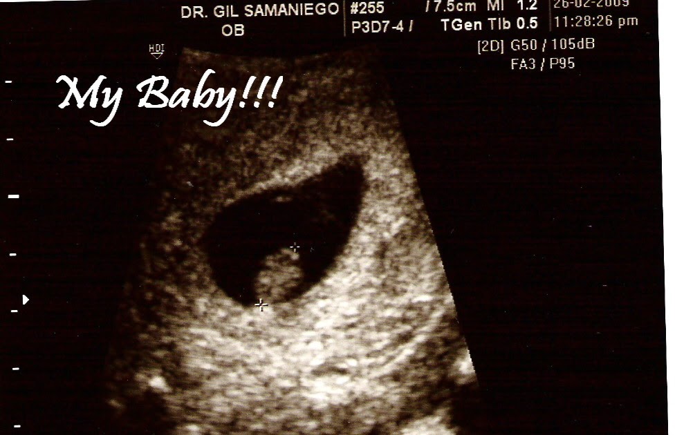 La espera de Nuestro Bebe...: TENGO 10 SEMANAS Y UN DIA DE EMBARAZO!! - Alas 10 Semanas De Embarazo Ya Se Mueve El Bebe