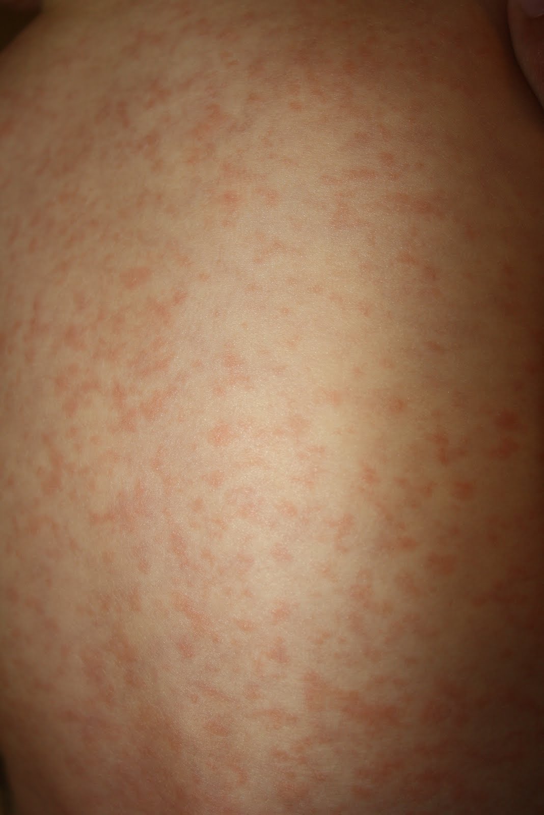 Stages Of Fifth Disease Rash