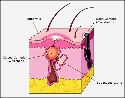Sebaceous cyst - Wikipedia