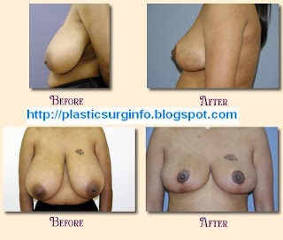 Breast Reduction and Breast Lift (before & after pictures)