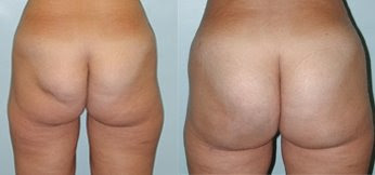 The Buttocks Before & After Weight Loss