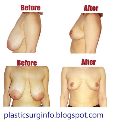 Breast Reduction and Breast Lift (before & after pictures)