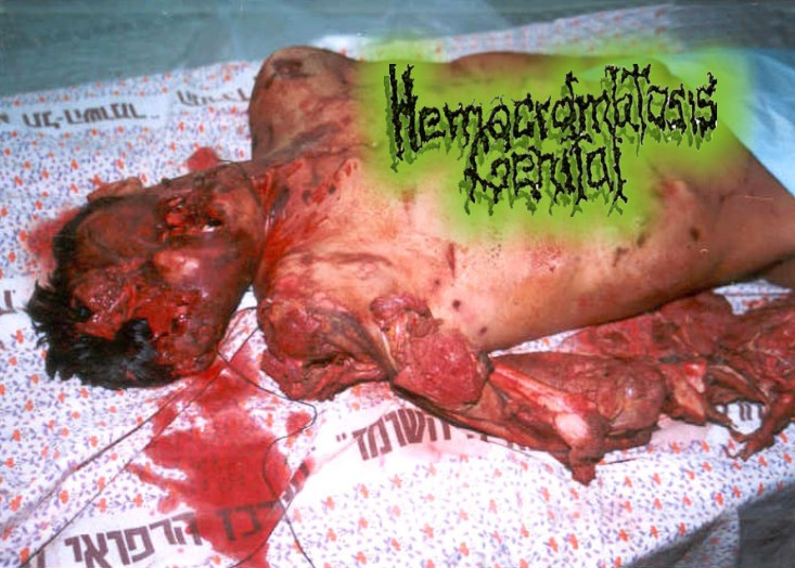 [Hemocromatosis+Genital+.jpg]