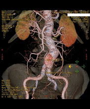 ANGIOSCANNER AORTE ABDOMINALE