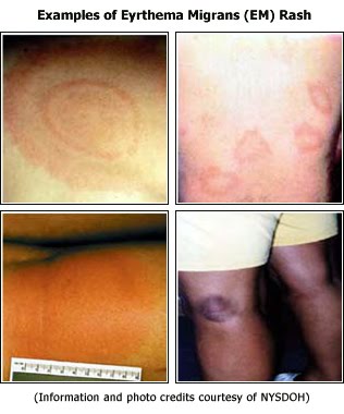 Parasite Rashes In Humans Global Environmental Health: Parasites and other icky things