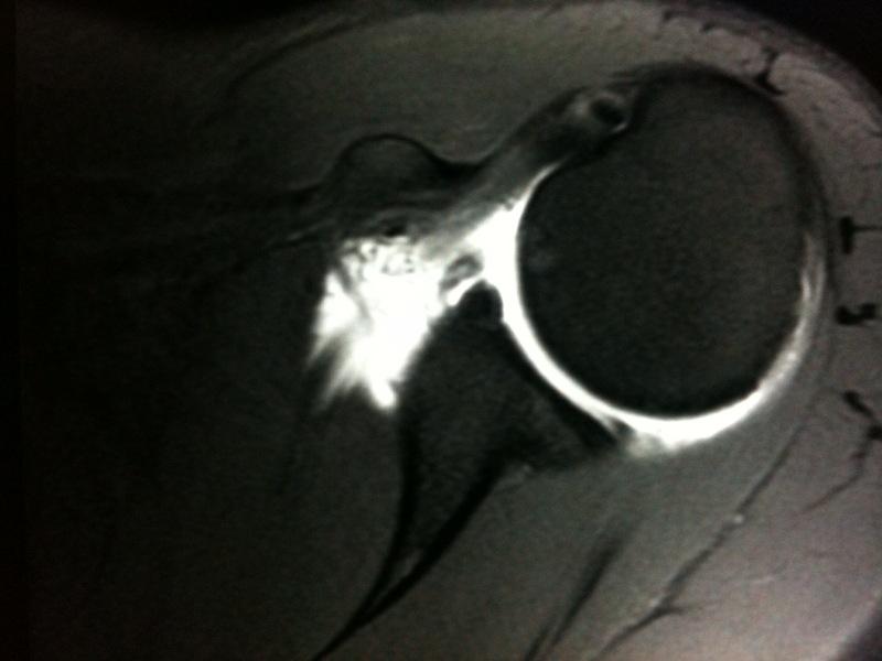 University of Toledo Radiology: Perthe's Lesion