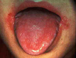 herpes around mouth #11