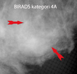 Фиброаденоматоз bi rads 2. Birads 4 стадии. Birads 4a. Bi-rads 2 молочной железы что это. Bi-rads 4a в молочной железе.