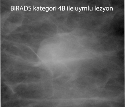 Rads 4b. Бирадс 3. Бирадс классификация. ФЖИ.олеогранулема.birads3, Тип 1.