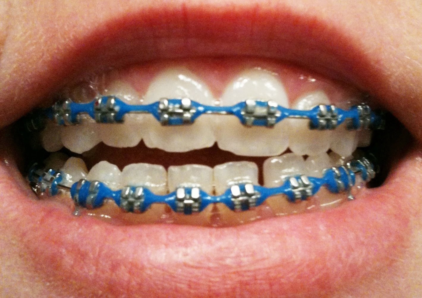 брекеты сердечки