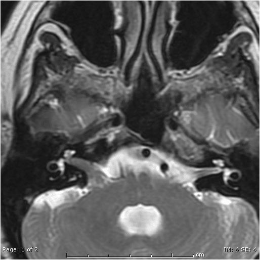 Mindys MRI Procedures Blog Acoustic Neuroma mindys-mri-procedures-blog-acoustic-neuroma