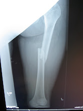 fracture du fémur